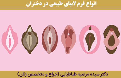انواع-فرم-لابیای-طبیعی-در-دختران