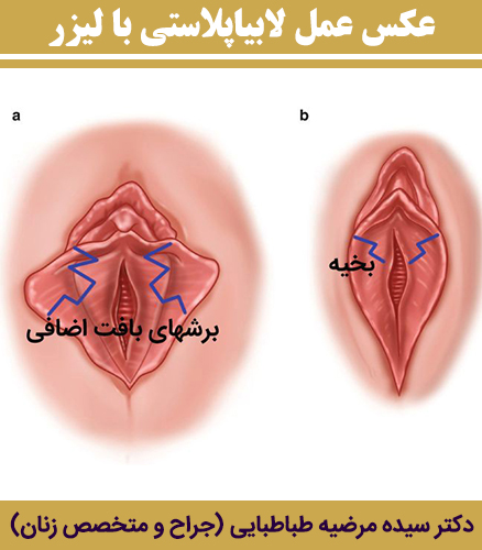 عکس-عمل-لابیاپلاستی-با-لیزر