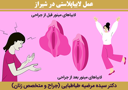 عمل-لابیاپلاستی-در-شیراز