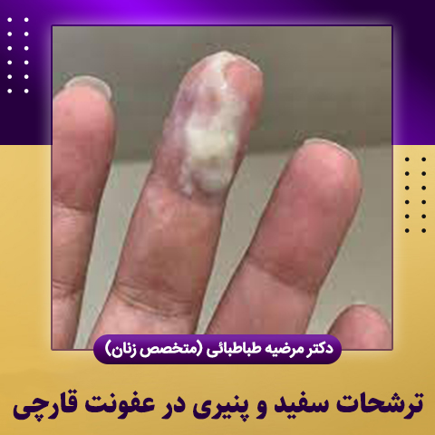 ترشحات-سفید-و-پنیری-در-عفونت-قارچی