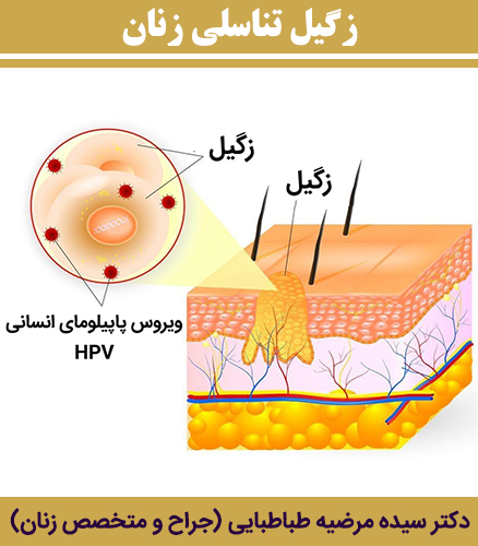 زگیل-تناسلی-زنان