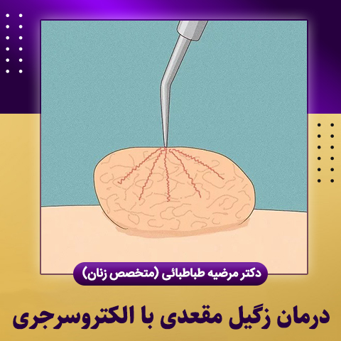 درمان-زگیل-مقعدی-با-الکتروسرجری