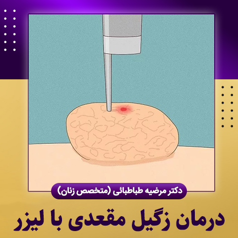 درمان-زگیل-مقعدی-با-لیزر