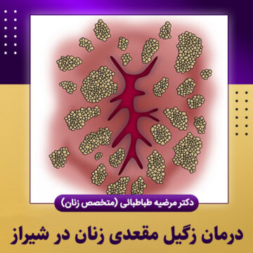 درمان-زگیل-مقعدی-زنان-در-شیراز